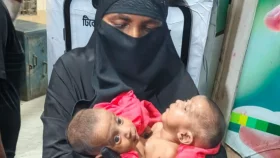 জোড়া লাগা যমজ দুটি শিশুর চিকিৎসা হবে সরকারি খরচে: স্বাস্থ্যমন্ত্রী