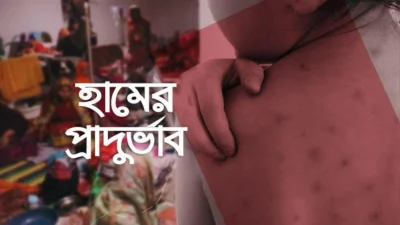 হামের প্রাদুর্ভাব। গ্রাফিক্স: বাংলা ট্রিবিউন