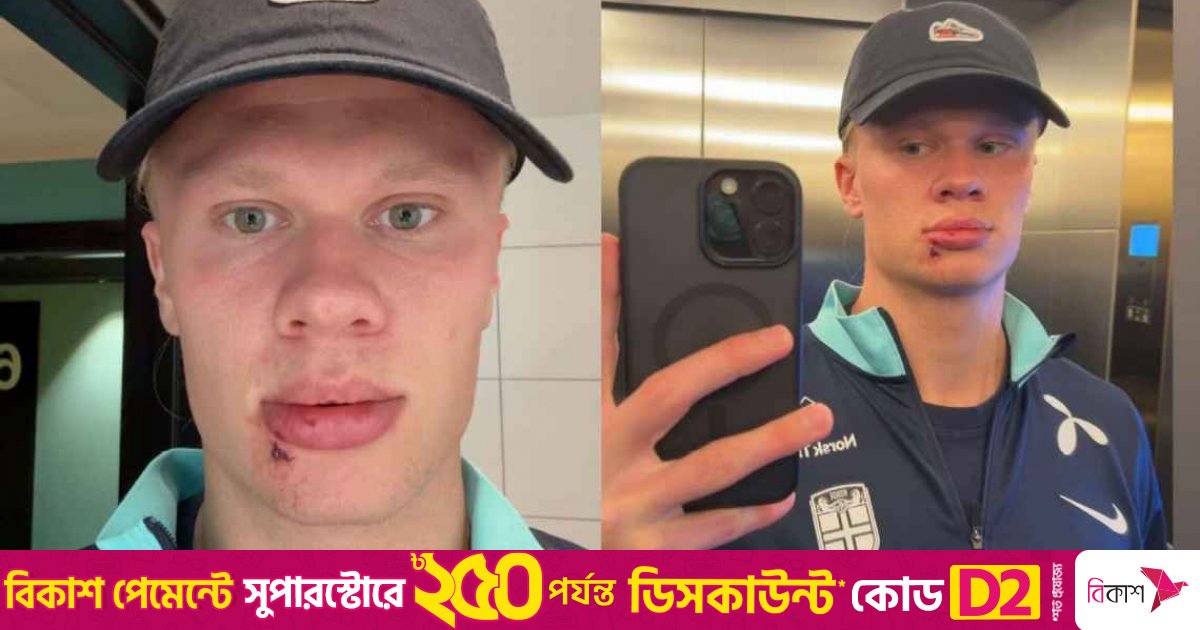 আঘাত পেয়ে ঠোঁটে সেলাই হাল্যান্ডের