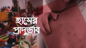সিলেটে হাম উপসর্গে ৩ জনের মৃত্যু