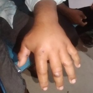 গাইবান্ধায় রোগাক্রান্ত গরু জবাই, ১১ জনের শরীরে অ্যানথ্রাক্সের উপসর্গ