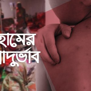 হাম ও উপসর্গে আরও ৭ মৃত্যু