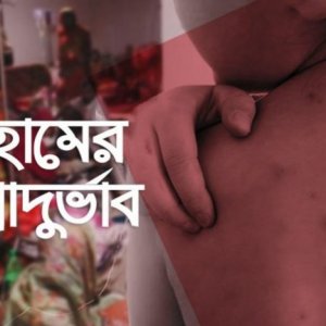 হামের উপসর্গে ফের প্রাণহানি, মোট মৃত্যু ৬৩১