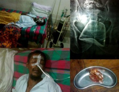 অপারেশনের পর হাসপাতালের বেডে জালাল এবং  পেট থেকে বের করা কাঁচের বোতল