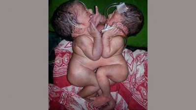পেটে জোড়া নিয়ে জন্মগ্রহণ করা হাসি-খুশি