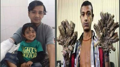 অপরেশনের পরে ও আগে বাজানদার