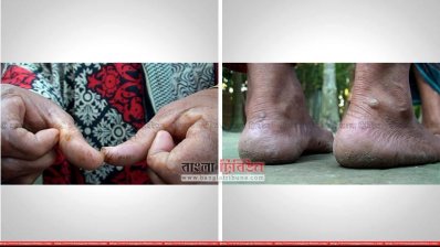 হাতে-পায়ে আর্সেনিকের ক্ষত (ছবি- প্রতিনিধি)