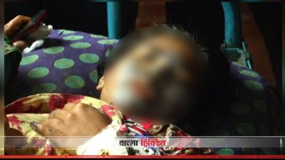এসিডদগ্ধ অবস্থায় চিকিৎসাধীন তানজিম আক্তার মালা