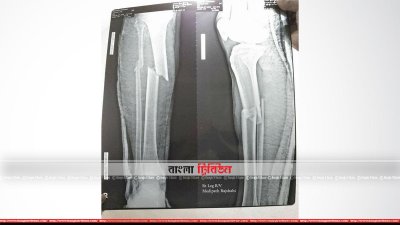 শুক্রবার নতুন করে পরীক্ষার পর তরিকুলের পায়ের এক্সরে ফিল্মের ছবি 