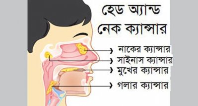 দেশে হেড-নেক ক্যান্সারে আক্রান্ত রোগীদের পরিসংখ্যান নেই
