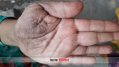 প্লেক্সিফর্ম নিউরোফাইব্রোমা রোগে আক্রান্ত যুথী সুস্থ হতে চায়