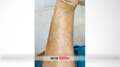 এসিড হামলার পর পারভেজ সানজারির হাতের একাংশ 
