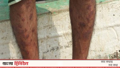 চর্মরোগে আক্রান্ত একজন