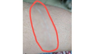 সুতায় কেটে যাওয়া হাত