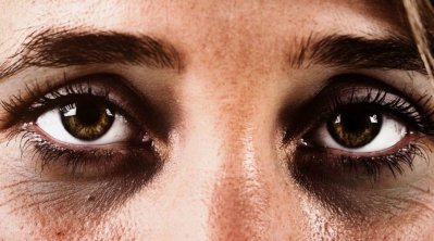 দুশ্চিন্তার কারণ যখন ডার্ক সার্কেল