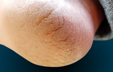 পা ফাটা থেকে প্রতিকারের উপায়