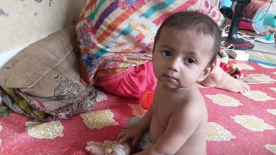 হামে আক্রান্ত শিশু