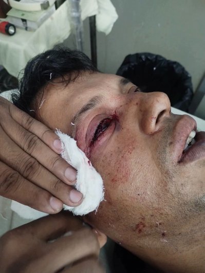 পাথরটি ট্রেনের জানালা ছিদ্র করে শ্যামলের ডান চোখে আঘাত হানে
