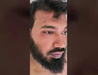 রাঙ্গুনিয়া রেঞ্জ কর্মকর্তা মেহরাজ উদ্দীনসহ বন বিভাগের একাধিক কর্মকর্তা-কর্মচারী আহত