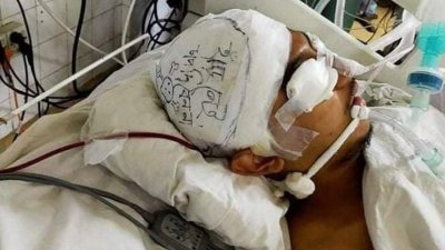 শারীরিক অবস্থার উন্নতি হওয়ায় লাইফ সাপোর্ট খুলে রাখা হয়েছে আকিবের