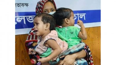 লাবিবা ও লাসিমাকে আলাদা করতে দ্বিতীয় অস্ত্রোপচার