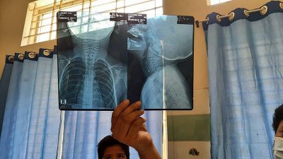 এক্স-রে রিপোর্টে গলায় আটকে থাকা সেফটিপিন