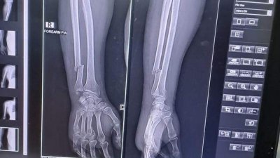 ভেঙে গেছে হাতের হাড়