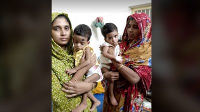 সফলভাবে আলাদা করা হয়েছে শিফা ও রিফাকে